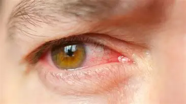 Penyebaran penyakit Mata Merah